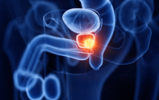 Improving PSMA PET scan accuracy