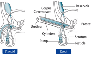 sex with a penile implant