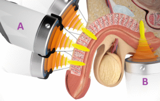 how shockwave therapy helped with ED